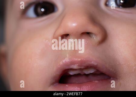 Visage d'un bébé garçon souriant avec un clin du nez. Écoulement nasal et congestion nasale chez l'enfant. Virus et infection bactérienne. Banque D'Images