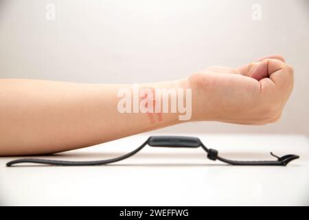 Irritation, rougeur et démangeaisons sur la peau après avoir porté une montre ou un bracelet fitness. Allergie au bracelet de montre, dermatite de contact. Banque D'Images