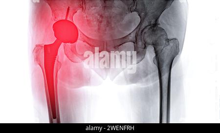Une radiographie révèle les deux articulations de la hanche avec ARTHROPLASTIE TOTALE DE LA HANCHE, mettant en évidence le succès de la procédure chirurgicale et fournissant un témoignage visuel de la Banque D'Images