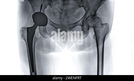 Une radiographie révèle les deux articulations de la hanche avec ARTHROPLASTIE TOTALE DE LA HANCHE, mettant en évidence le succès de la procédure chirurgicale et fournissant un témoignage visuel de la Banque D'Images