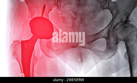 Une radiographie révèle les deux articulations de la hanche avec ARTHROPLASTIE TOTALE DE LA HANCHE, mettant en évidence le succès de la procédure chirurgicale et fournissant un témoignage visuel de la Banque D'Images