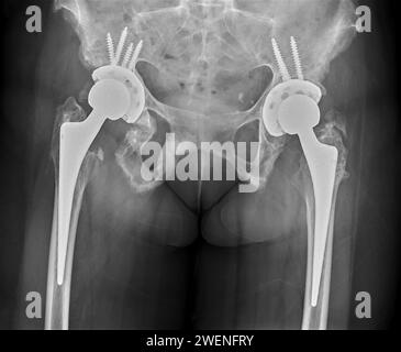 Une radiographie révèle les deux articulations de la hanche avec ARTHROPLASTIE TOTALE DE LA HANCHE, mettant en évidence le succès de la procédure chirurgicale et fournissant un témoignage visuel de la Banque D'Images