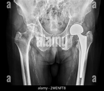 Une radiographie révèle les deux articulations de la hanche avec ARTHROPLASTIE TOTALE DE LA HANCHE, mettant en évidence le succès de la procédure chirurgicale et fournissant un témoignage visuel de la Banque D'Images