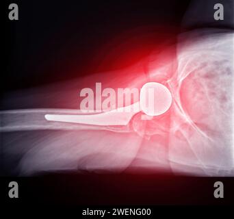 Une radiographie révèle les deux articulations de la hanche avec ARTHROPLASTIE TOTALE DE LA HANCHE, mettant en évidence le succès de la procédure chirurgicale et fournissant un témoignage visuel de la Banque D'Images