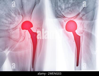 Une radiographie révèle les deux articulations de la hanche avec ARTHROPLASTIE TOTALE DE LA HANCHE, mettant en évidence le succès de la procédure chirurgicale et fournissant un témoignage visuel de la Banque D'Images