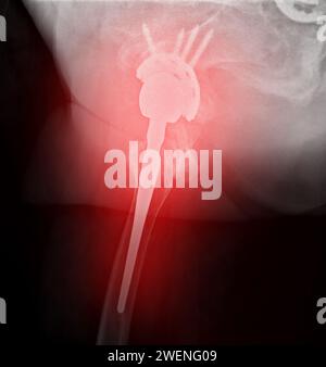 Une radiographie révèle les deux articulations de la hanche avec ARTHROPLASTIE TOTALE DE LA HANCHE, mettant en évidence le succès de la procédure chirurgicale et fournissant un témoignage visuel de la Banque D'Images