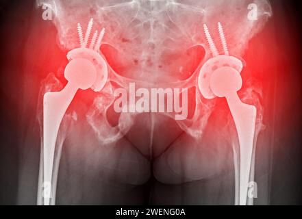 Une radiographie révèle les deux articulations de la hanche avec ARTHROPLASTIE TOTALE DE LA HANCHE, mettant en évidence le succès de la procédure chirurgicale et fournissant un témoignage visuel de la Banque D'Images