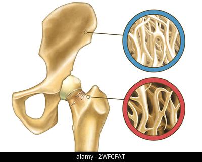 Gros plan du squelette montrant un os normal et une ostéoporose. Illustration numérique. Banque D'Images