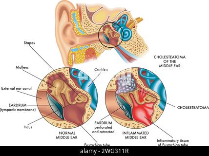 Illustration médicale comparant la partie interne de l'oreille (oreille moyenne) à gauche saine et à droite atteinte de cholestéatome, avec annotati Illustration de Vecteur
