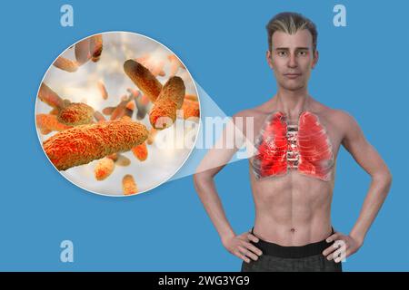 Homme avec des poumons affectés par une pneumonie, illustration Banque D'Images