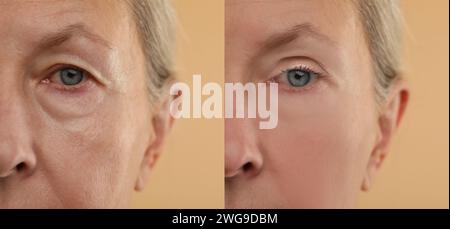Modifications cutanées vieillissantes. Femme montrant le visage avant et après le rajeunissement, gros plan. Collage comparant l'état de la peau Banque D'Images