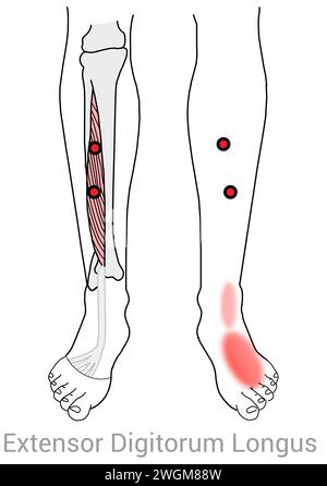 Extensor digitorum Longus : points de déclenchement myofascial causant des douleurs le long du tibia dans la cheville et le pied plus d'autres emplacements de douleur associés Banque D'Images