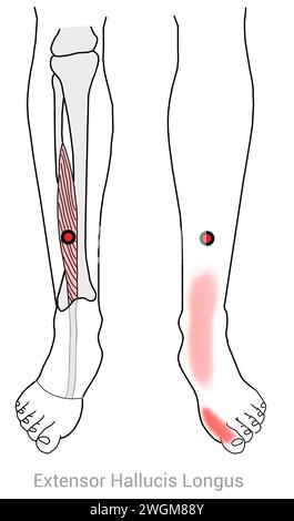 Extenseur hallucis Longus : points déclencheurs myofasciaux causant des douleurs dans le gros orteil et d'autres emplacements de douleur associés Banque D'Images