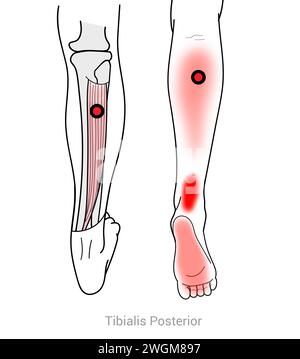 Tibialis Posterior : gestion de la douleur dans les mollets, les archilles et la plante du pied arrivant des points de déclenchement Myofascial dans le tibialis Posterior Banque D'Images