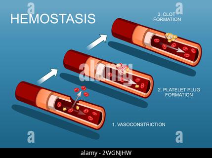 Hémostase et cicatrisation. Coagulation. Étapes de base de la vasoconstriction à la formation du bouchon plaquettaire. Coupe transversale d'une artère. Vaisseau sanguin inju Illustration de Vecteur