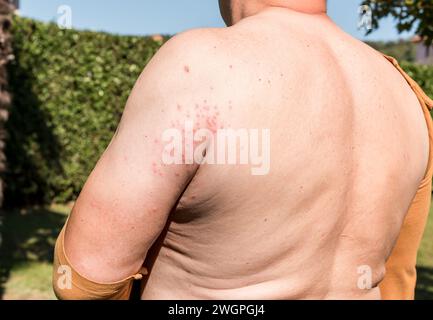 Le bras de l'homme avec éruption cutanée, symptômes de démangeaisons, allergie cutanée. Banque D'Images