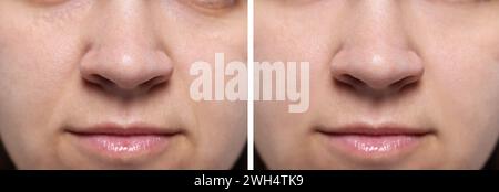 Modifications cutanées vieillissantes. Femme montrant le visage avant et après le rajeunissement, gros plan. Collage comparant l'état de la peau Banque D'Images