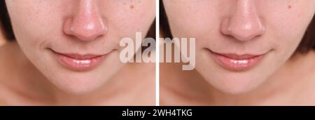 Modifications cutanées vieillissantes. Femme montrant le visage avant et après le rajeunissement, gros plan. Collage comparant l'état de la peau Banque D'Images