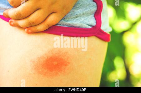 La piqûre de tique sur la jambe d'un enfant, gros plan. Allergie aux piqûres d'insectes. Plaie et conséquences après piqûre de moustique. Peau acnéique Banque D'Images