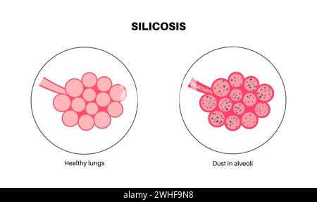 Poussière de silicose dans le poumon, illustration Banque D'Images