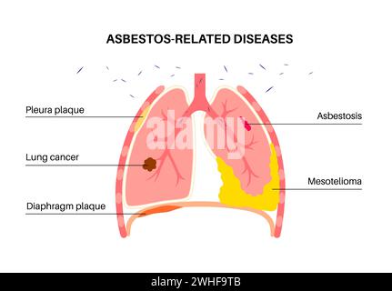 Maladies liées à l'amiante, illustration Banque D'Images