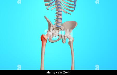 Fracture intertrochantérienne du squelette de la tête fémorale illustration médicale 3D. Banque D'Images