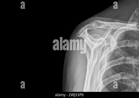 Radiographie d'un lumineux d'épaule isolé sur fond noir. Luxation chronique du biceps long Banque D'Images