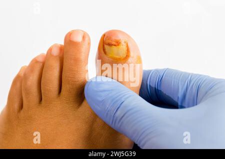 Gros plan du médecin qui contrôle l'orteil gauche qui souffre d'un ongle cassé Banque D'Images