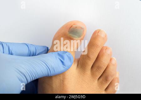 Gros plan d'un médecin examinant l'ongle de l'orteil gauche souffrant d'hématome sous-unguéal bleu et noir ongle de l'orteil Banque D'Images
