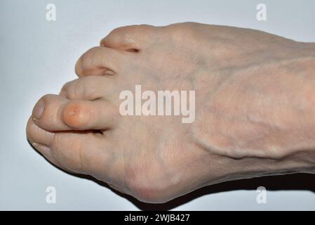 La photo montre une vue de dessus du pied droit d'une femme atteinte de la maladie de Hulux valgus, les orteils sont tordus. Banque D'Images