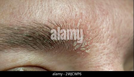 Macro-cliché d'un sourcil avec dermatite séborrhéique. Psoriasis eczéma pelliculaire sur les sourcils d'un jeune adulte. PROB. Peau Banque D'Images