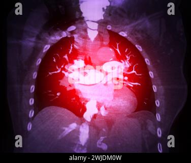 Une artère pulmonaire TDM révèle une vue détaillée des vaisseaux sanguins pulmonaires, capturant la présence d'une embolie pulmonaire, une condition où une cl de sang Banque D'Images