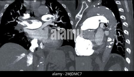 Une artère pulmonaire TDM révèle une vue détaillée des vaisseaux sanguins pulmonaires, capturant la présence d'une embolie pulmonaire. Banque D'Images