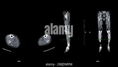 Un veinogramme CT de la jambe est une procédure d'imagerie non invasive offrant des images détaillées des veines de la jambe. Banque D'Images