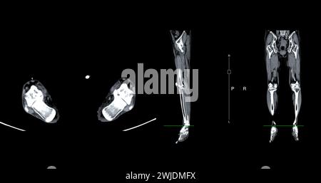 Un veinogramme CT de la jambe est une procédure d'imagerie non invasive offrant des images détaillées des veines de la jambe. Banque D'Images