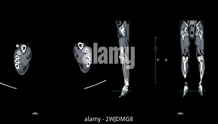 Un veinogramme CT de la jambe est une procédure d'imagerie non invasive offrant des images détaillées des veines de la jambe. Banque D'Images