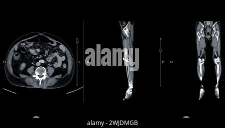 Un veinogramme CT de la jambe est une procédure d'imagerie non invasive offrant des images détaillées des veines de la jambe. Banque D'Images