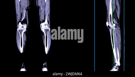 Un veinogramme CT de la jambe est une procédure d'imagerie non invasive offrant des images détaillées des veines de la jambe. Banque D'Images