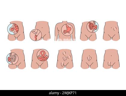 Icônes de ligne herniaire définies. Elément isolé par vecteur. Contour modifiable. Illustration de Vecteur