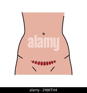 Icône de ligne d'incision de Pfannenstiel. Incisions abdominales. Elément isolé par vecteur. Contour modifiable. Illustration de Vecteur