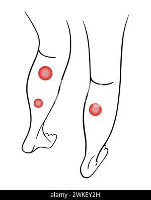 Varices des membres inférieurs. Traitement des varices. Illustration de Vecteur