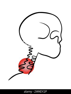 Illustration vectorielle isolée de douleurs des vertèbres cervicales. Tracé du contour de la région cervicale avec localisation de la douleur dans les vertèbres. Illustration de Vecteur