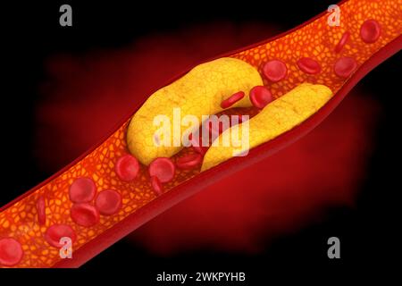 Plaque coronaire Clogget dans l'artère, artère bloquée avec Bad cholestérol sur un fond sombre. Rendu 3D. Banque D'Images