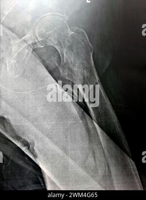 Radiographie simple avec une forte probabilité de fracture sous-trochantérienne, de fracture trochantérienne et de métastase maligne dans la partie médiane de la diaphyse fémorale en dessous Banque D'Images