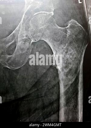 Radiographie simple avec une forte probabilité de fracture sous-trochantérienne, de fracture trochantérienne et de métastase maligne dans la partie médiane de la diaphyse fémorale en dessous Banque D'Images