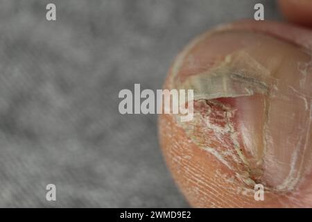 Maladies fongiques des ongles et de la peau des pieds gros plan. Podologie et options de traitement pour les plaques à ongles. Banque D'Images