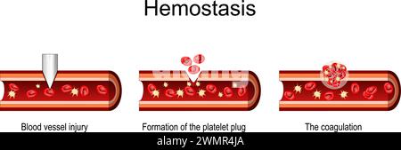 Hémostase. Coupe transversale d'un vaisseau sanguin après lésion, formation du bouchon plaquettaire, coagulation et cicatrisation. Illustration vectorielle Illustration de Vecteur