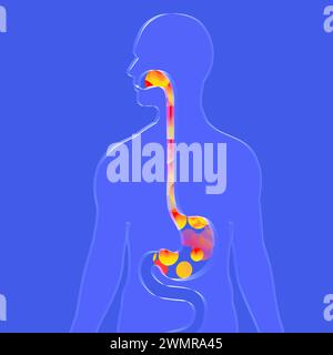 3e illustration de l'oesophage avec reflux gastrique et brûlures d'estomac. Avec des boules de feu. Système digestif et silhouette humaine en verre transparent. Banque D'Images