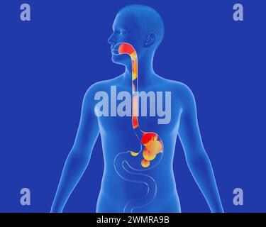 Illustration anatomique 3D de l'estomac et de l'œsophage avec reflux vers la bouche. Avec ardeur et feu. Système digestif et figure humaine transparente. Banque D'Images