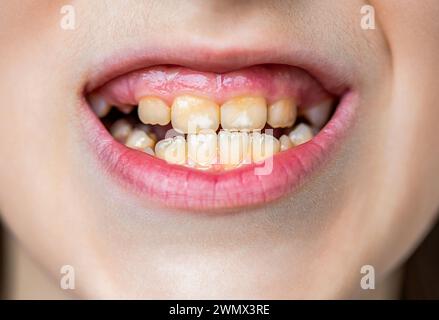 Gros plan des dents malsaines de bébé. Ouvrez la bouche d'un petit garçon avec des dents mal poussées en gros plan. Le concept d'orthodontie et de stomatologie. Mauvais Banque D'Images